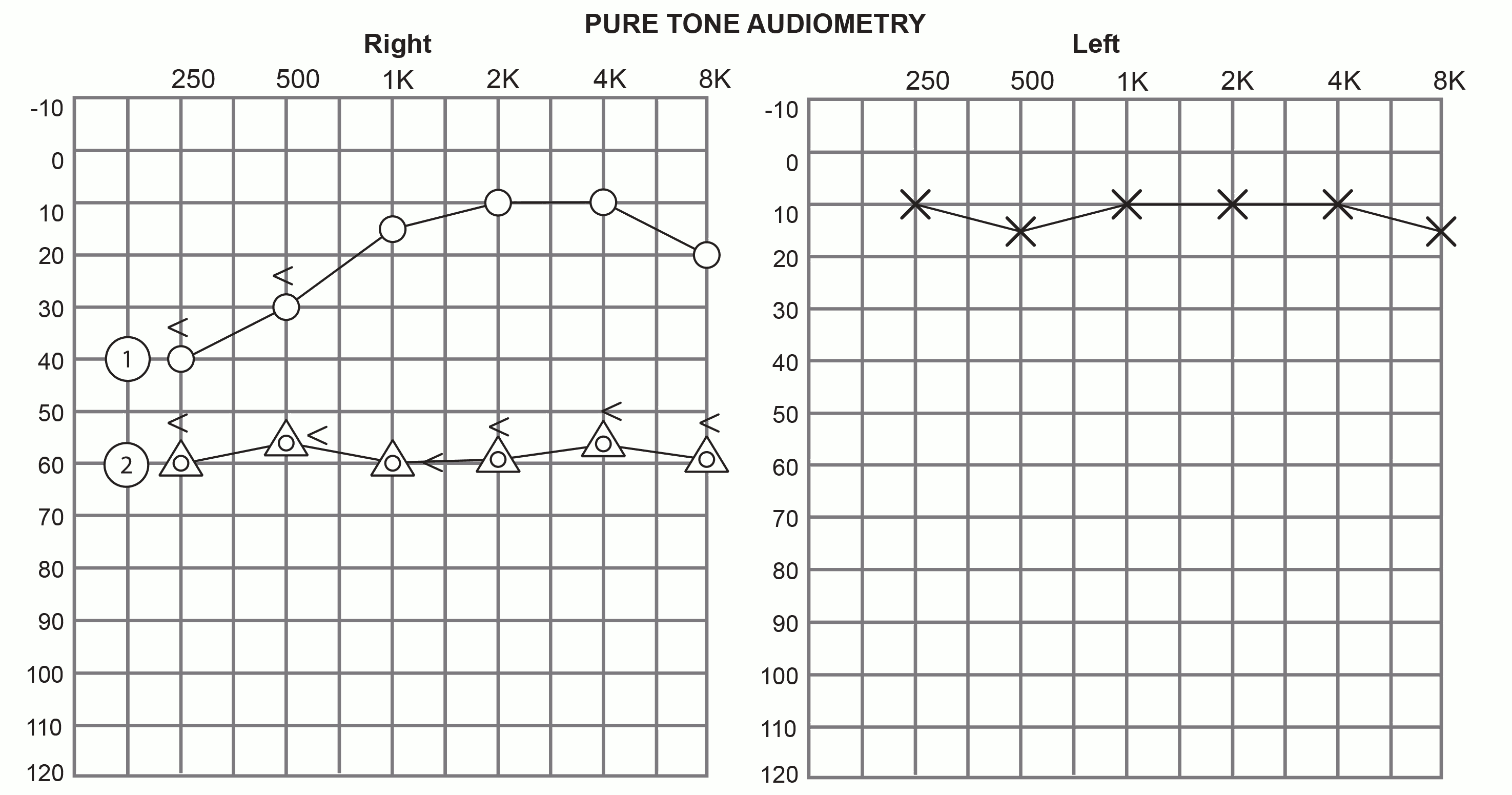 Typical Menière's audiogram